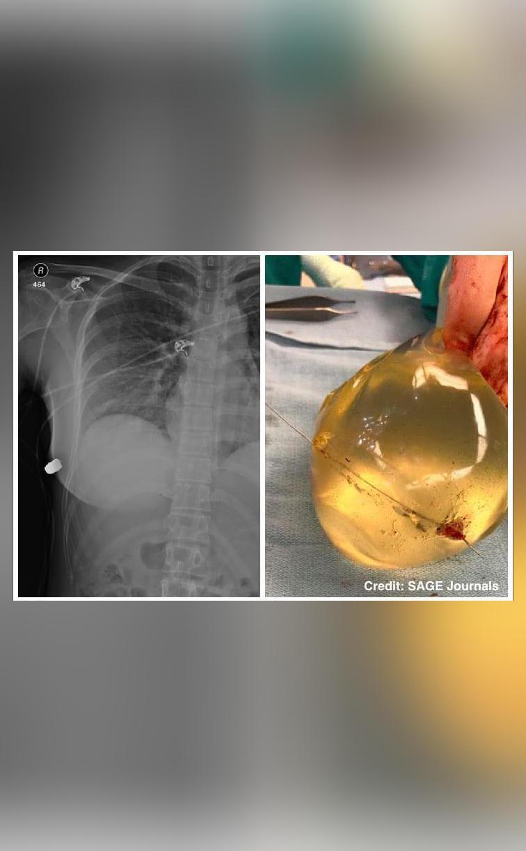Womans Breast Implant Deflects Bullet Away From Her Heart Saves Her
