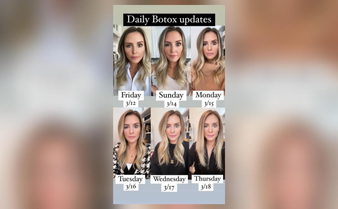 Influencer Posts Pics Of Falling Eyelid After Bad Botox At Medical Influencer Posts Pics Of Falling Eyelid After Bad Botox At Medical