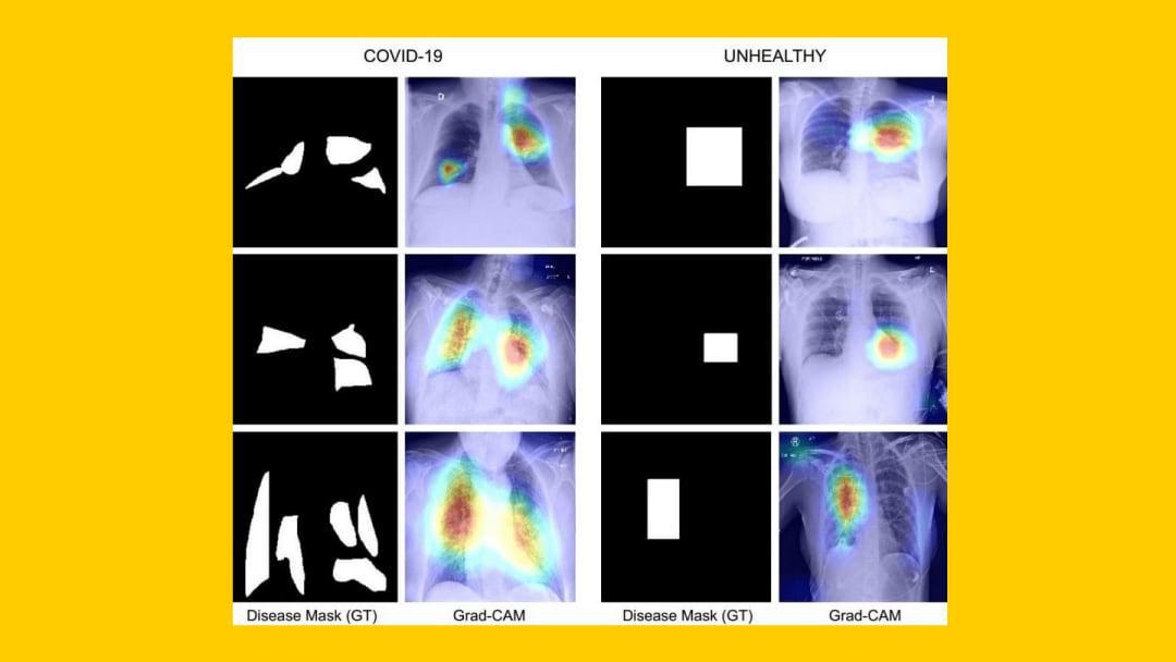 IIT Jodhpur develops technique to diagnose COVID using chest Xray