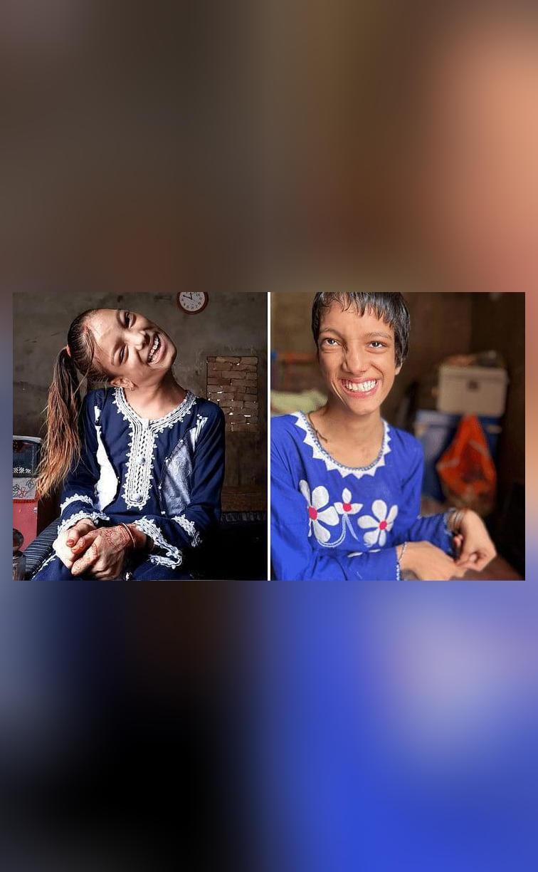 13yrold Pakistani girl with neck bent at 90 degree treated by Indian doctor for free Feel