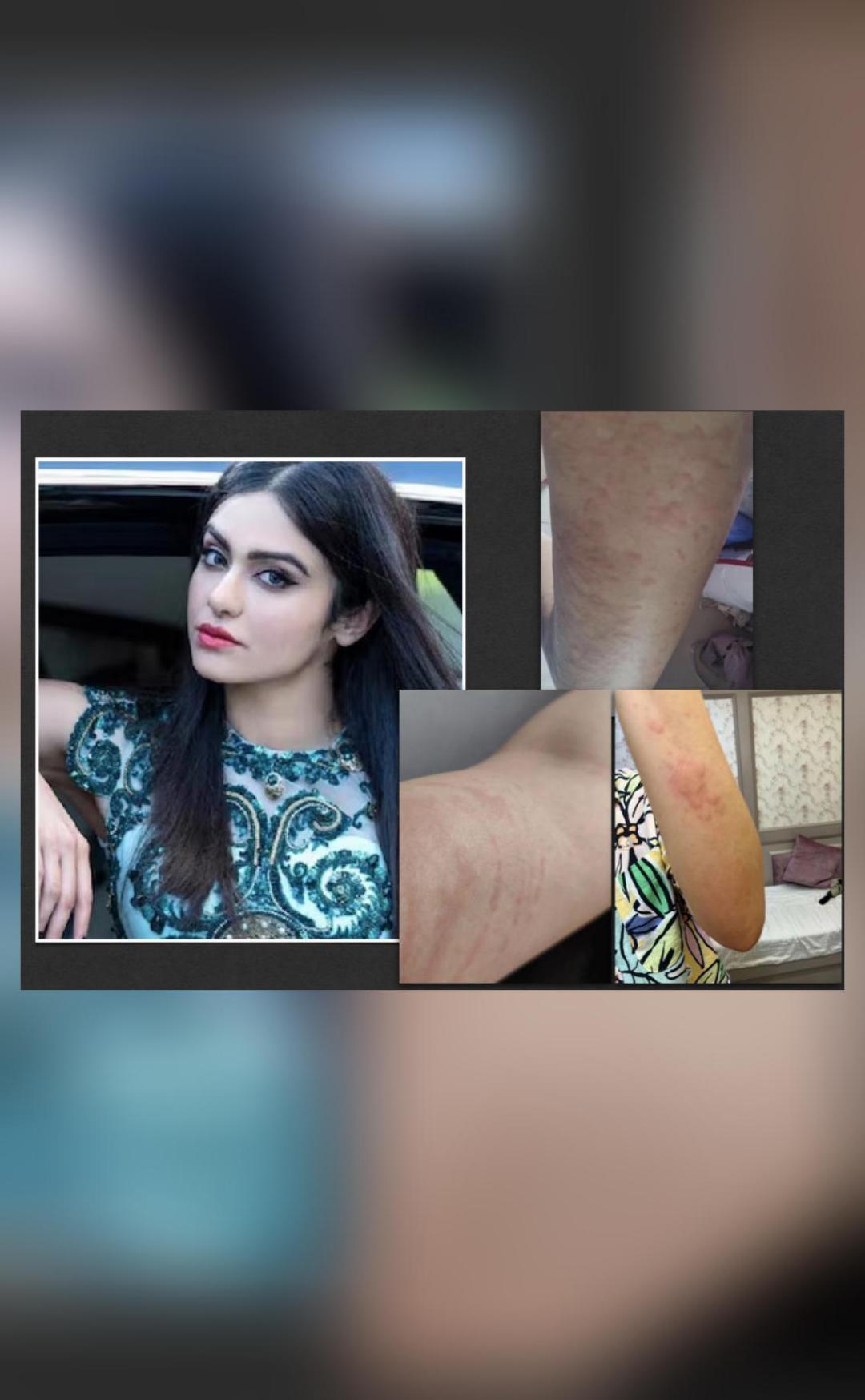 Adah Sharma says she's suffering from hives, shares pics