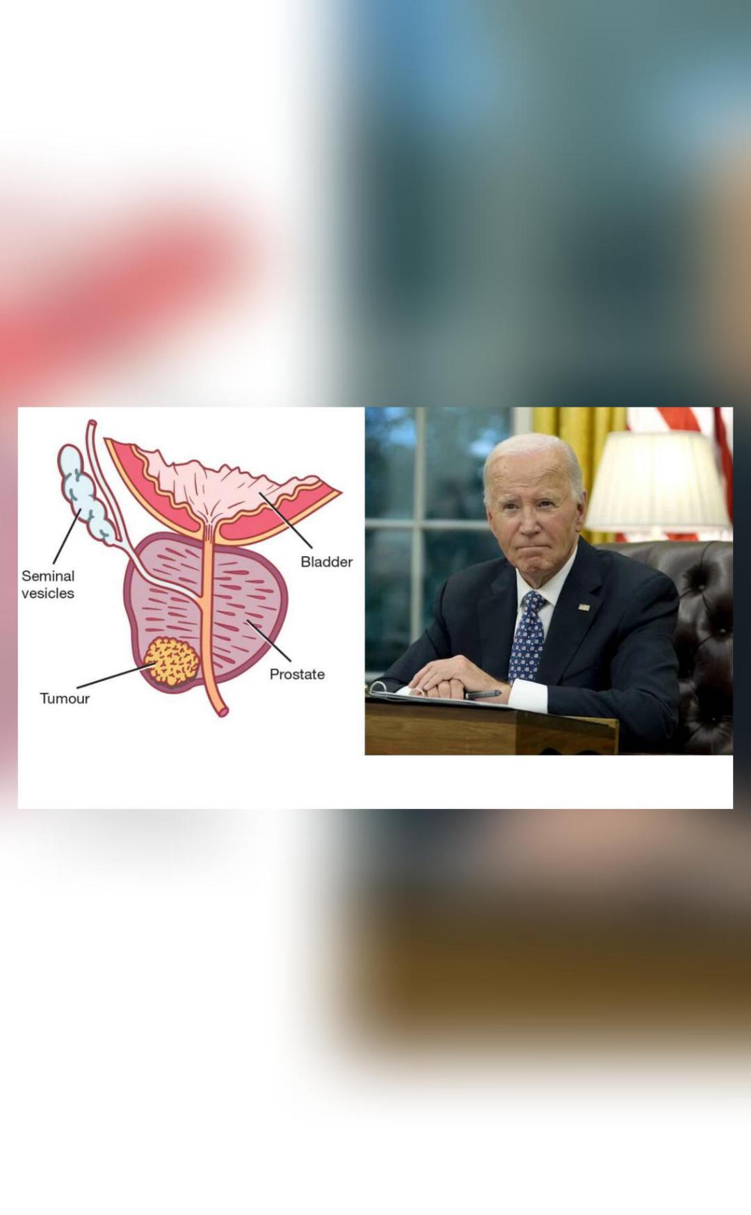 What is prostate cancer, disease affecting ex-US Prez Joe Biden?