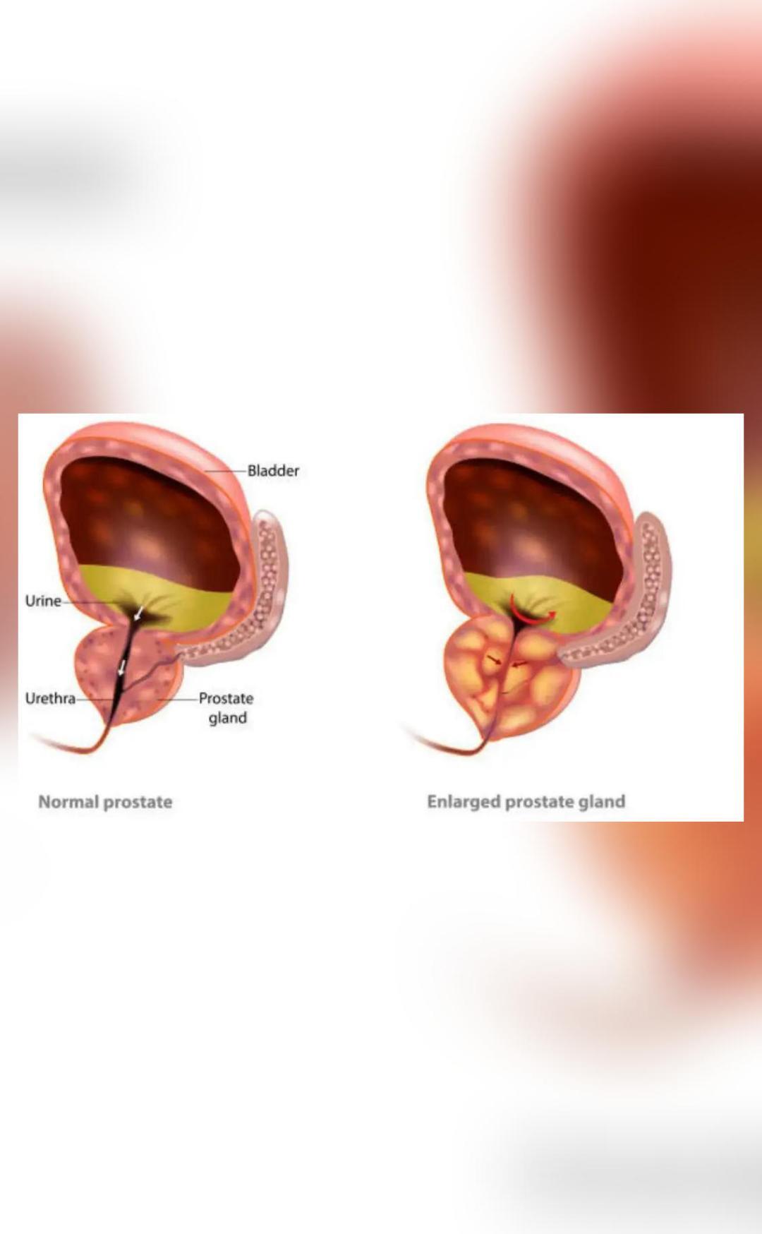 Prostate Rinse img_1750182202601_593.jpg?