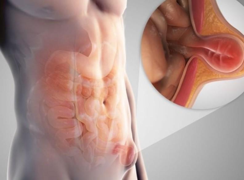 Understanding Hernias: From early signs to surgery