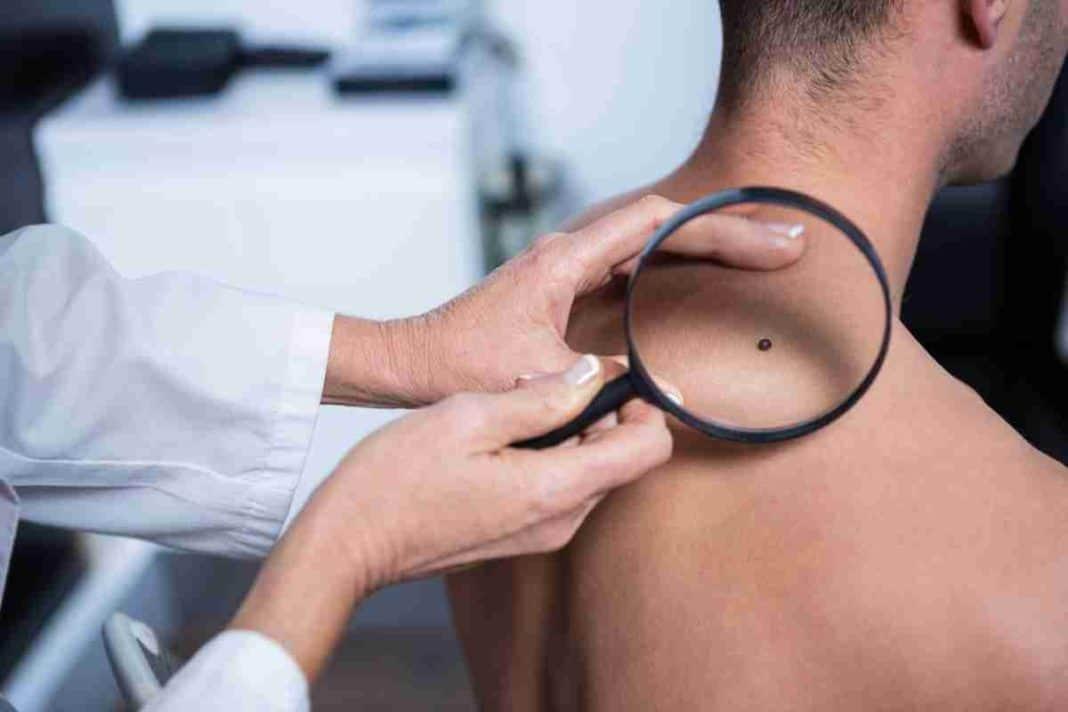 Can warts and moles be removed safely by using creams?