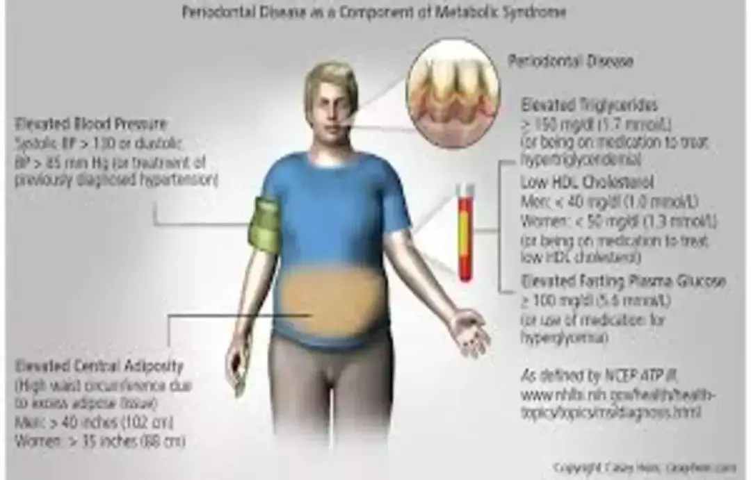 Obesity linked to increased severity of gum disease: Study
